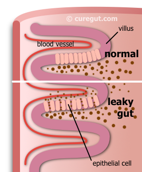 Leaky Gut